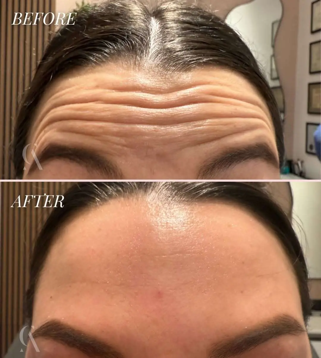 Botox forehead before and after example