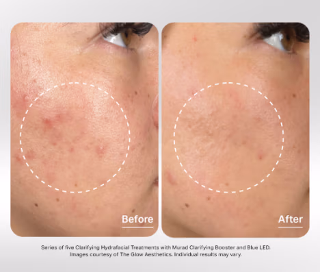 Hydrafacial acne before and after example