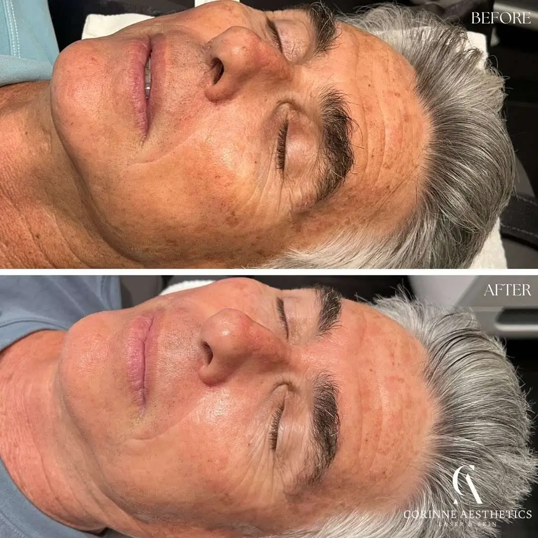 Hydrafacial before and after example