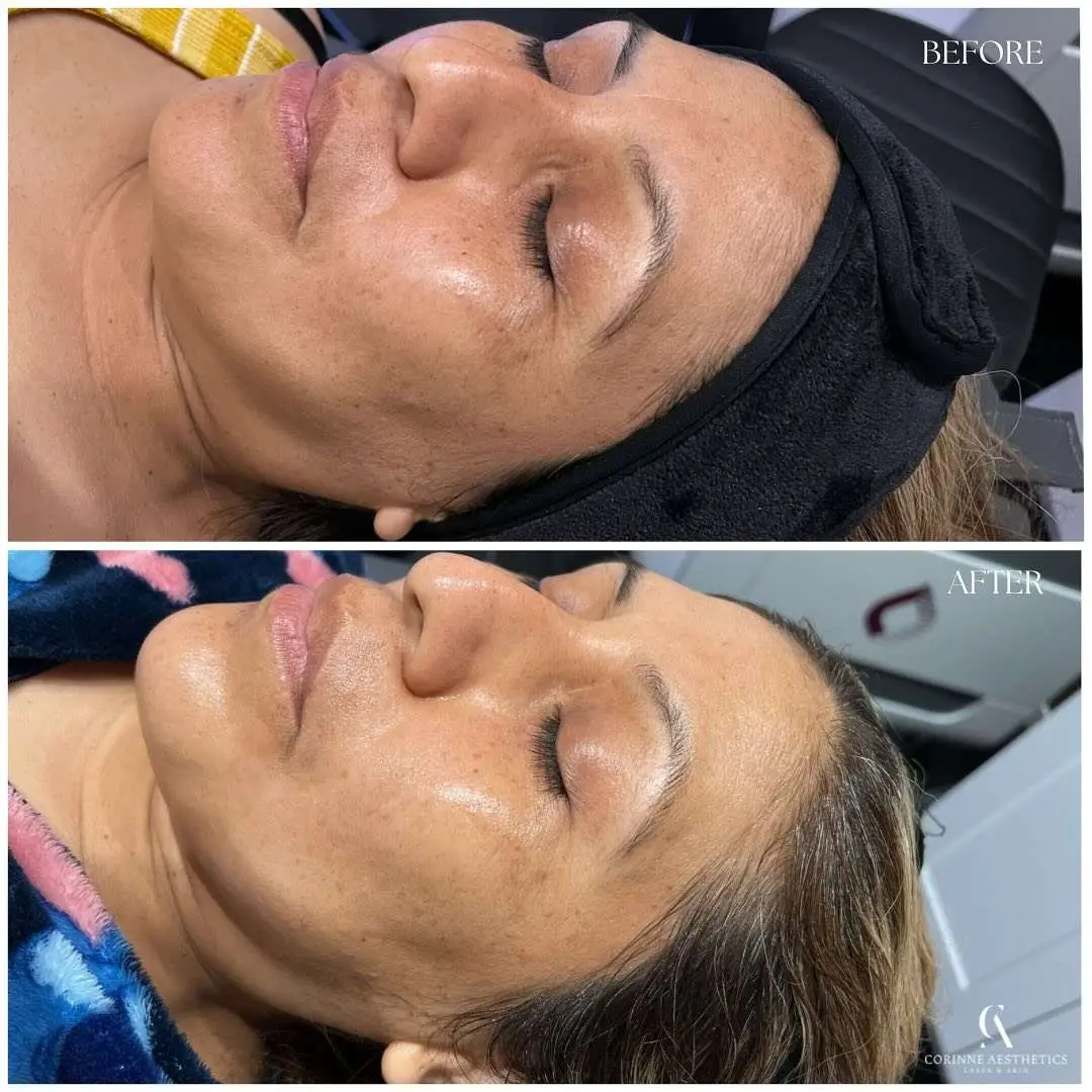 Hydrafacial before and after example