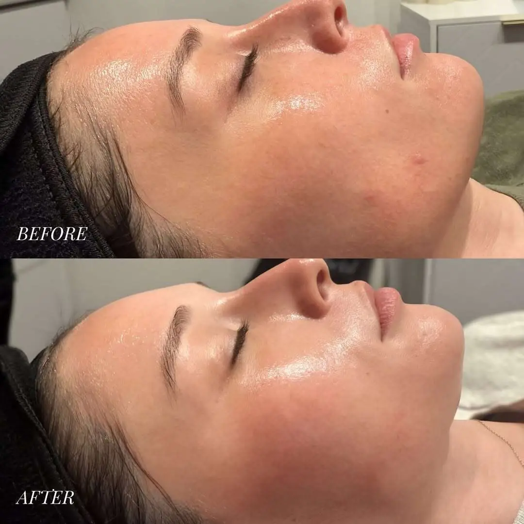 Hydrafacial before and after example