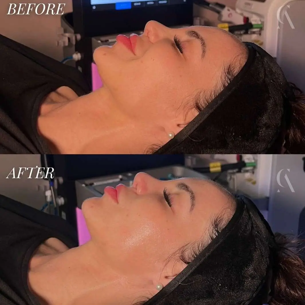 Hydrafacial before and after example