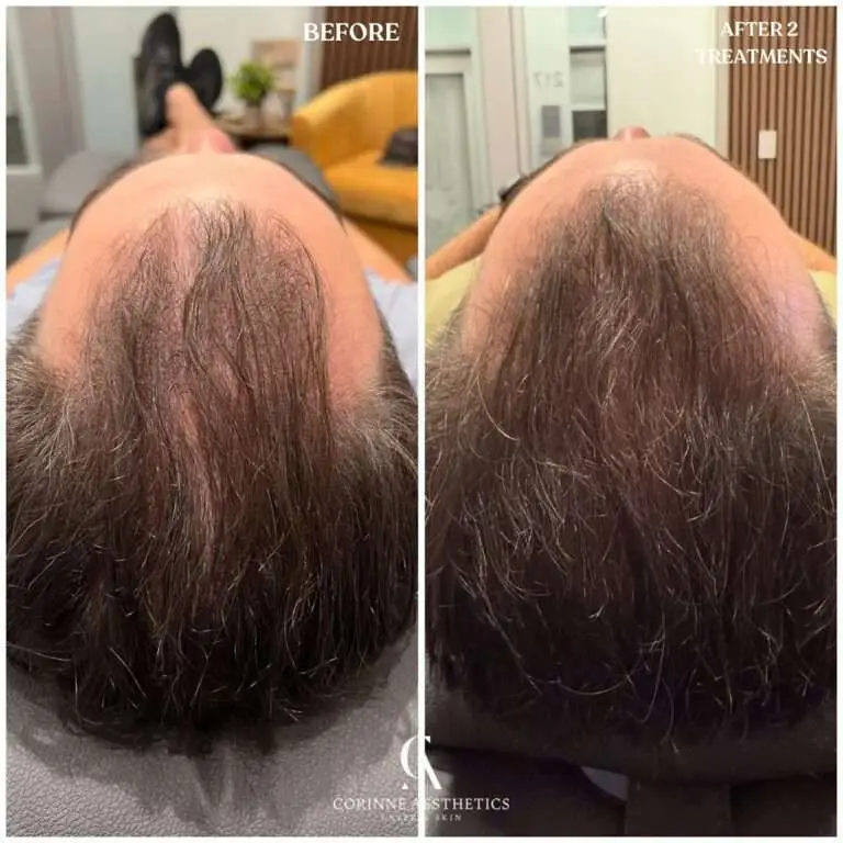 HydraScalp crown before and after example