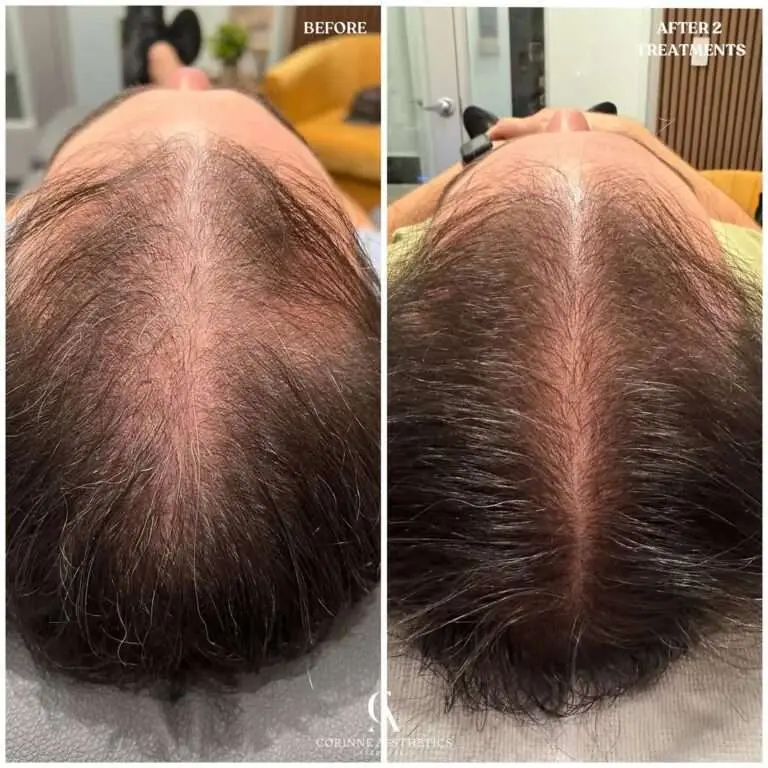 HydraScalp part line before and after example