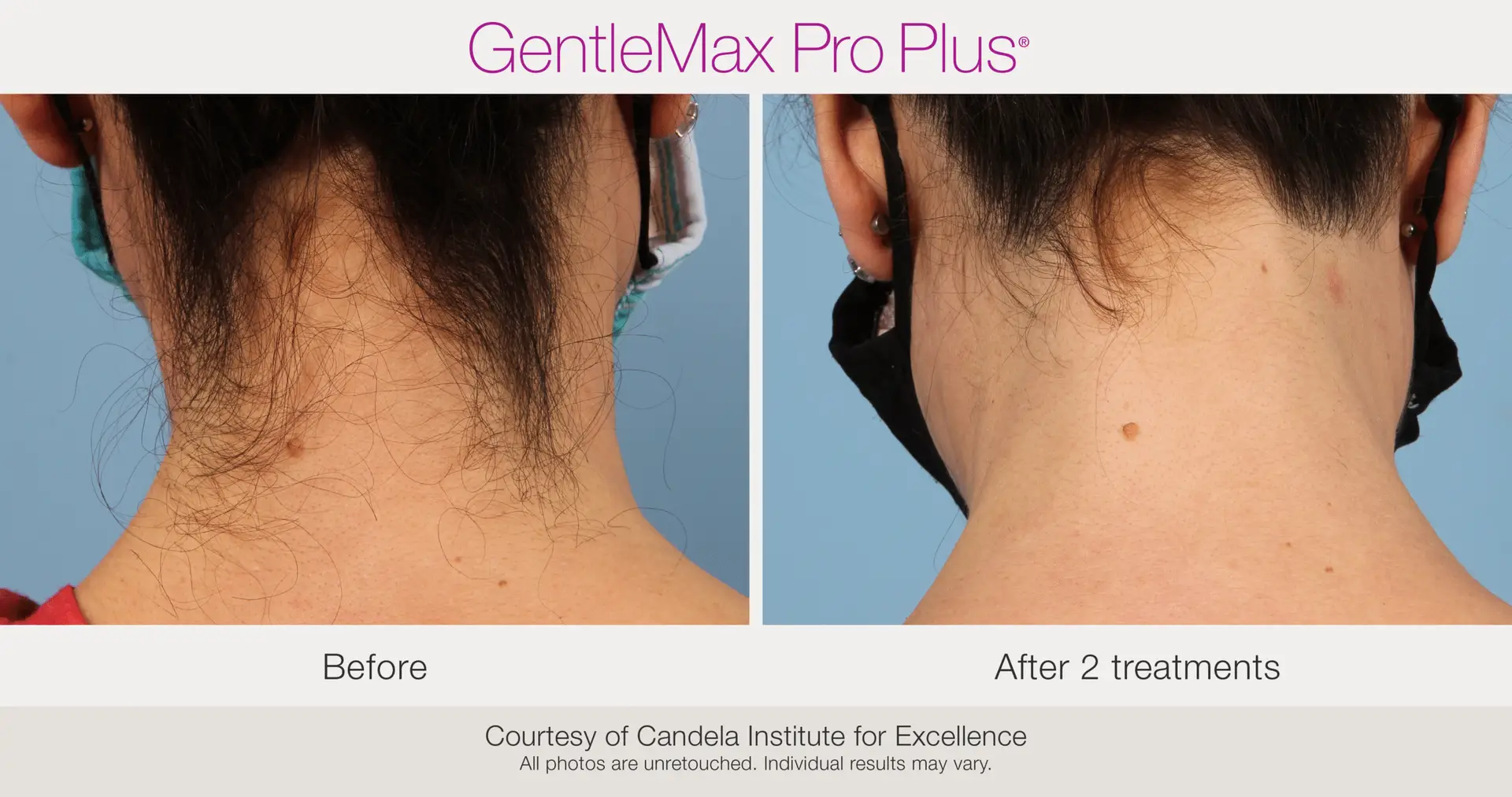 Laser Hair Removal before and after example