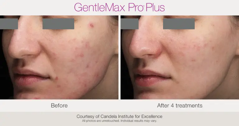 Laser facial redness and texture before and after example