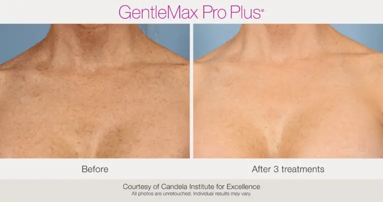 Laser facial chest pigment before and after example