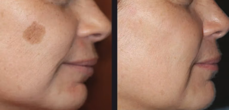 Laser facial pigment before and after example