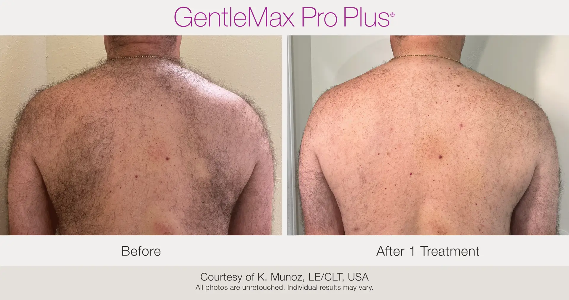 Laser Hair Removal before and after example