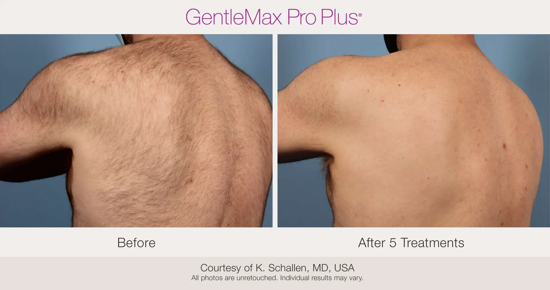 Laser Hair Removal before and after example