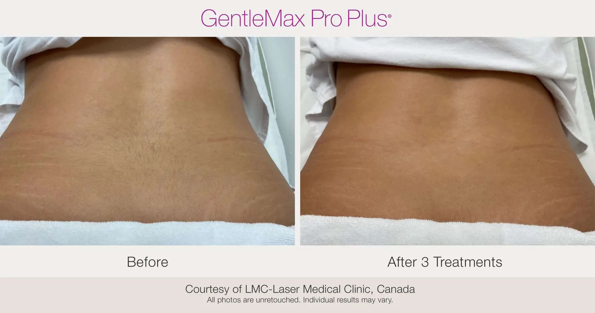 Laser Hair Removal lower back before and after example