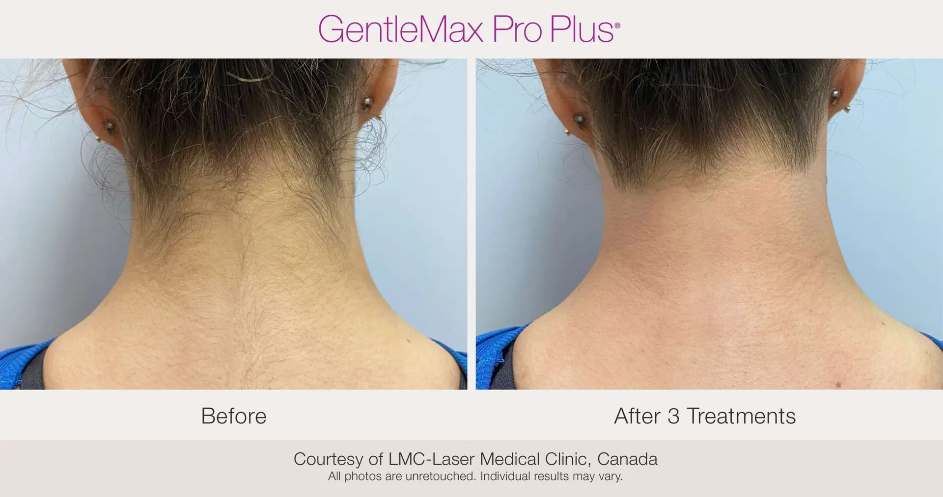 Laser Hair Removal neck before and after example