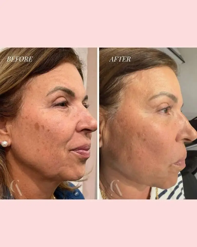 Microneedling before and after skin quality example
