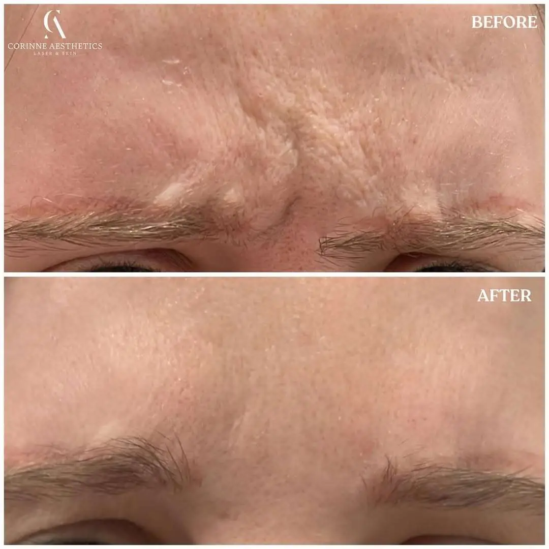 Botox before and after example