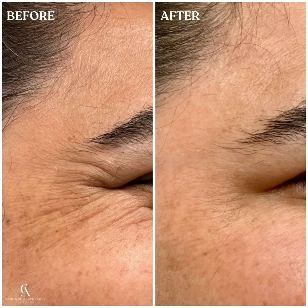 Neurotoxin before and after example