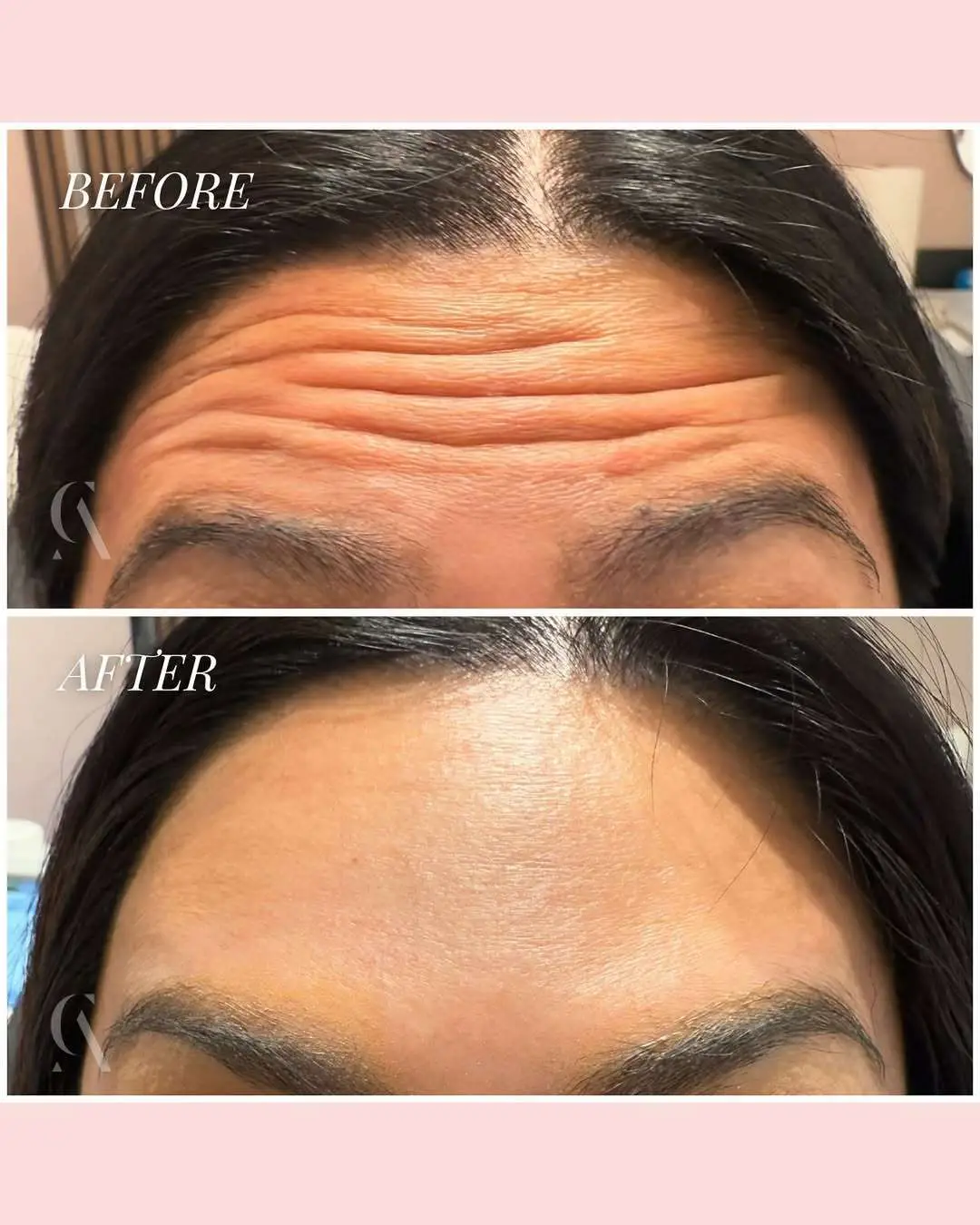 Botox before and after example