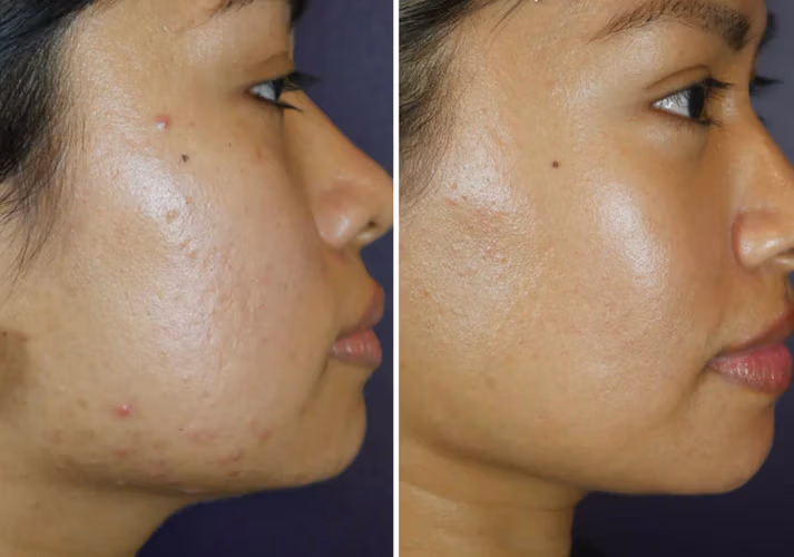 Microneedling SkinStylus before and after example