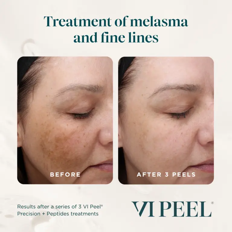 VI Peel melasma and fine lines before and after example