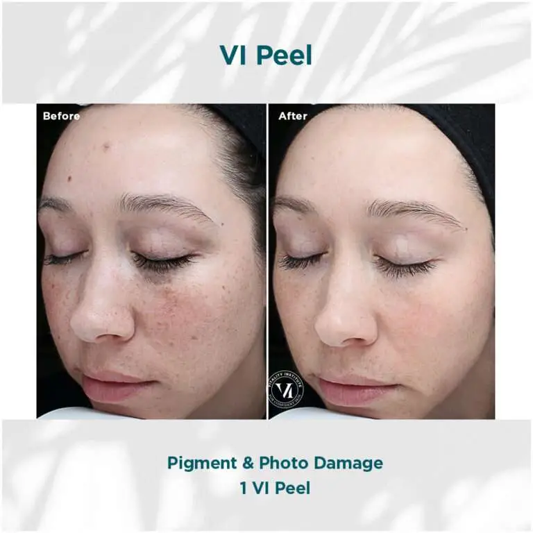 VI Peel pigment and photo damage before and after example