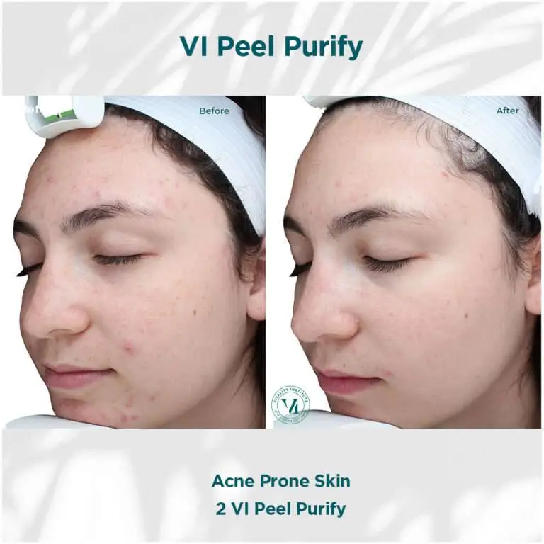 VI Peel Purify acne-prone skin before and after example