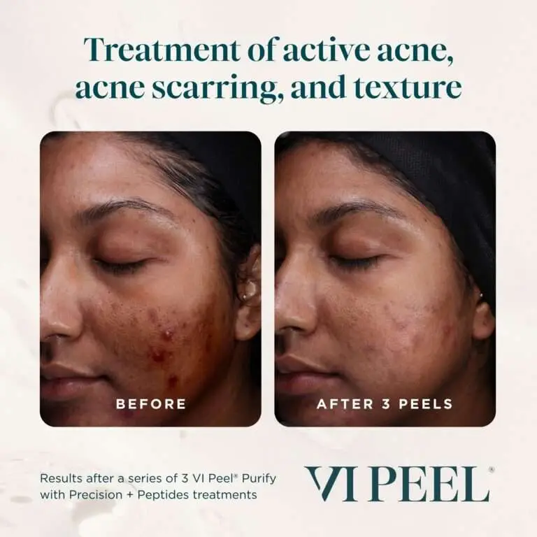 VI Peel active acne and texture before and after example