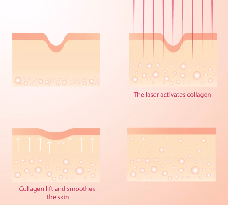 Diagram showing laser heat activation of collagen and skin smoothing