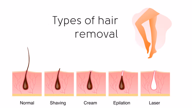 Laser hair removal compared with shaving waxing and plucking infographic