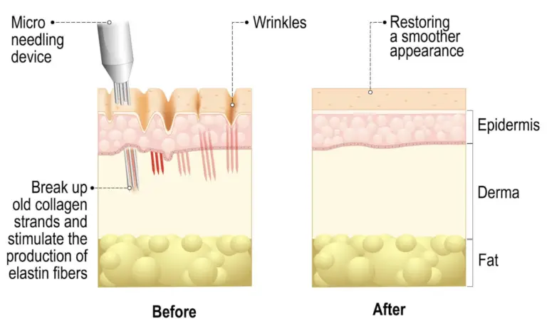 Microneedling collagen remodeling mechanism infographic
