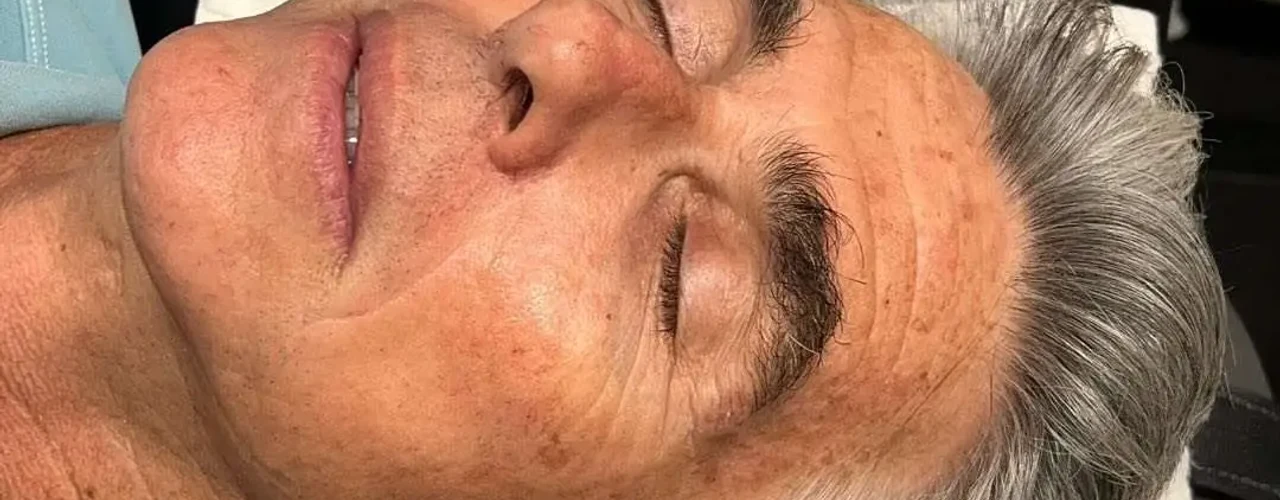 Hydrafacial before treatment example