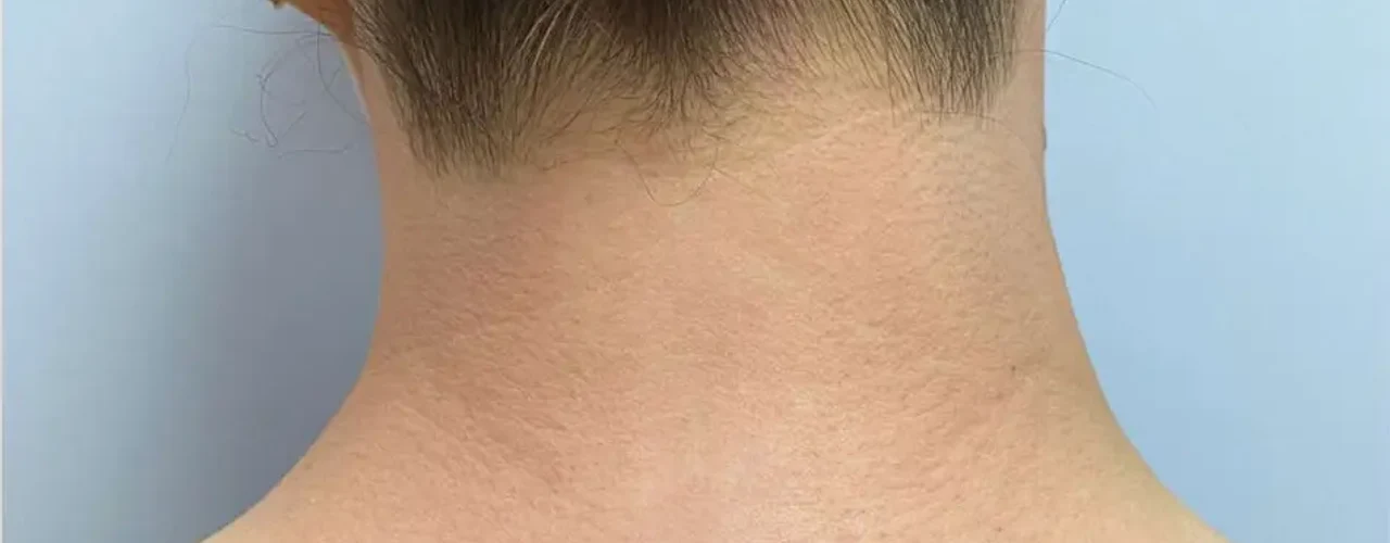 Laser Hair Removal after treatment example