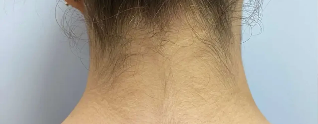 Laser Hair Removal before treatment example