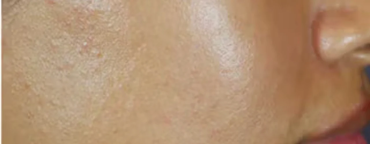 Microneedling after treatment example