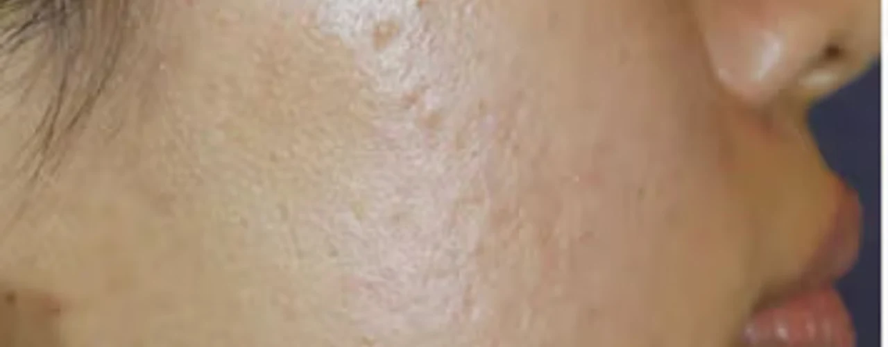 Microneedling before treatment example