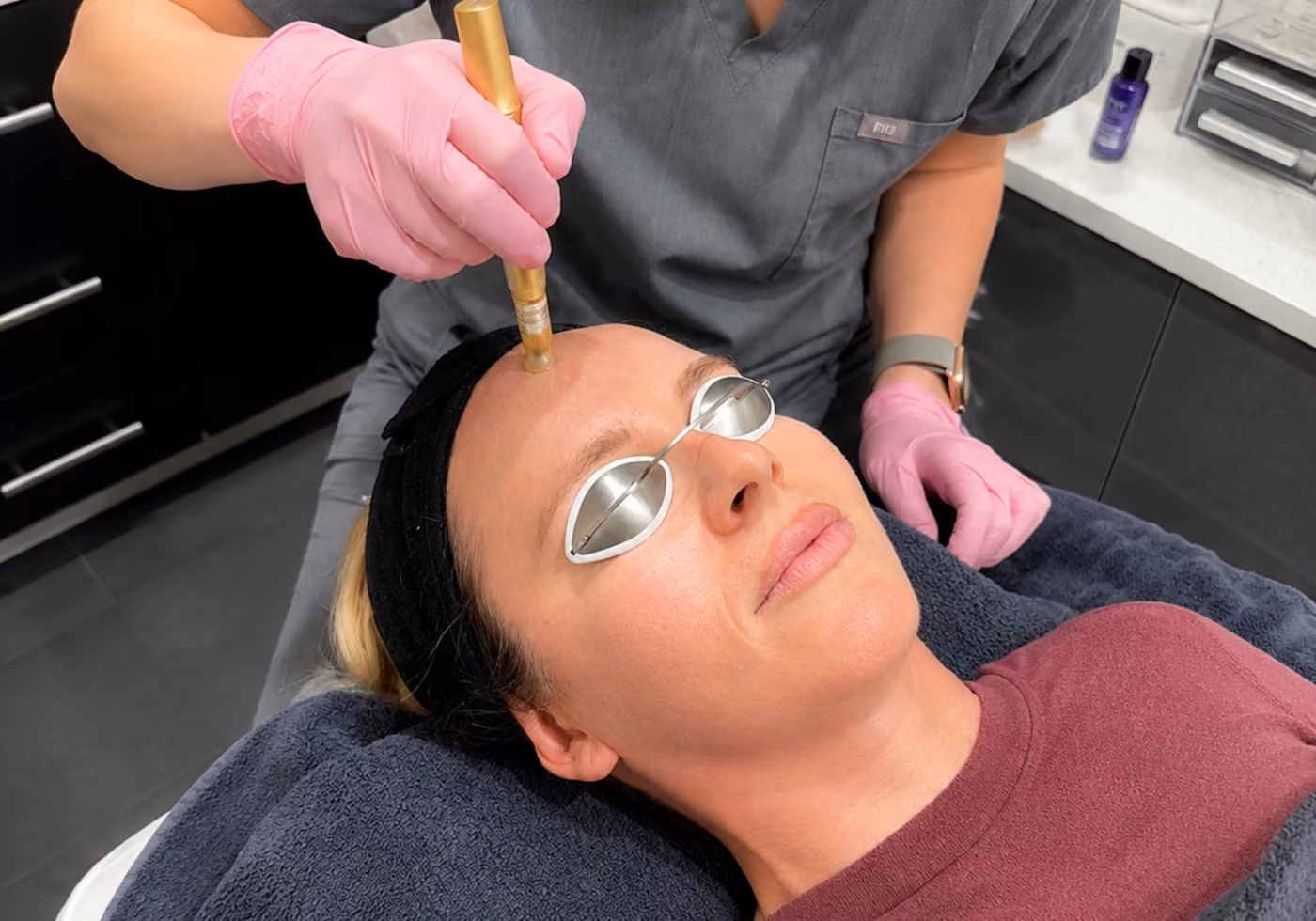 Microneedling treatment close-up at Corinne Aesthetics
