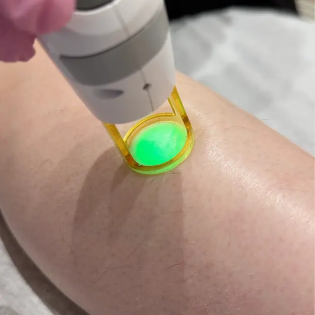 Laser hair removal area illustration for full legs