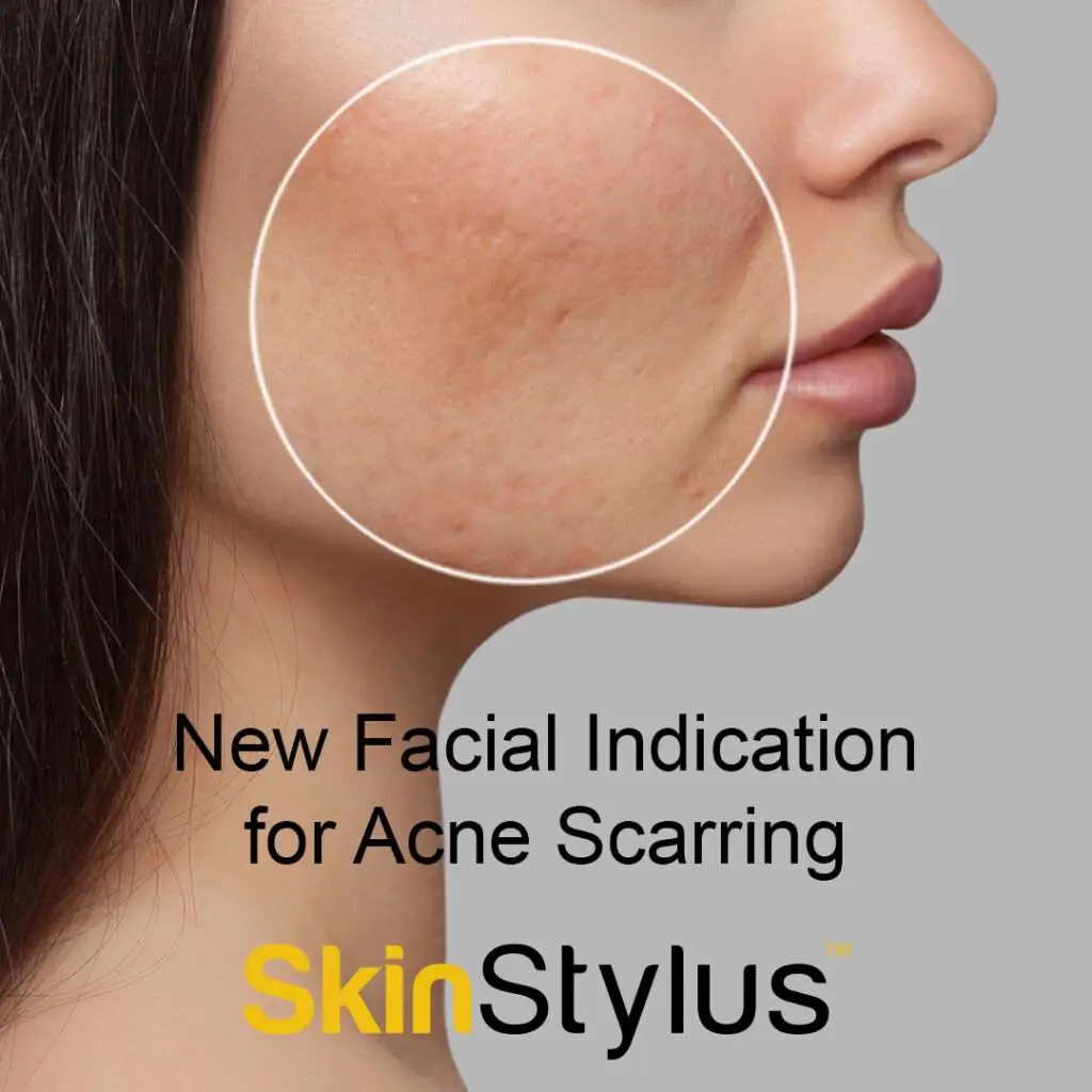 Microneedling treatment in Thousand Oaks