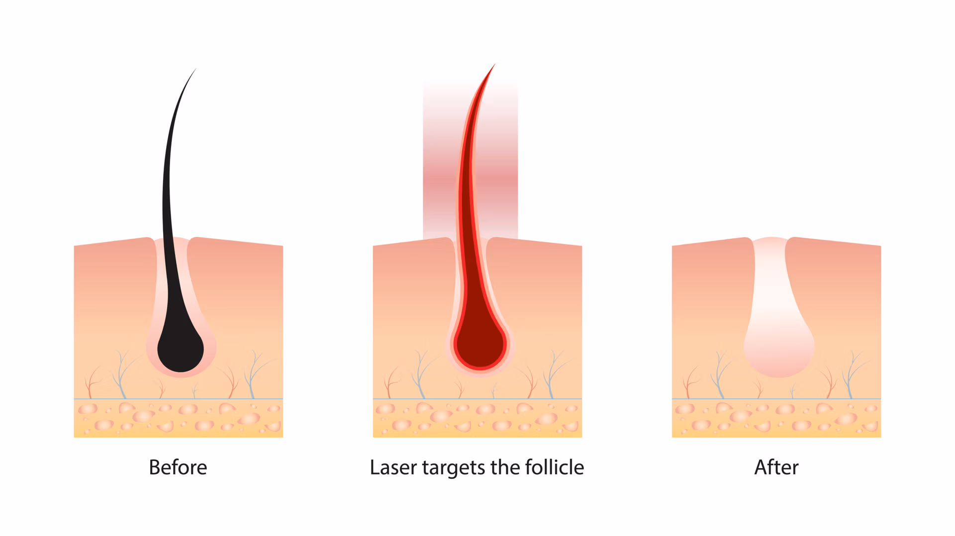 Laser Hair Removal in Thousand Oaks