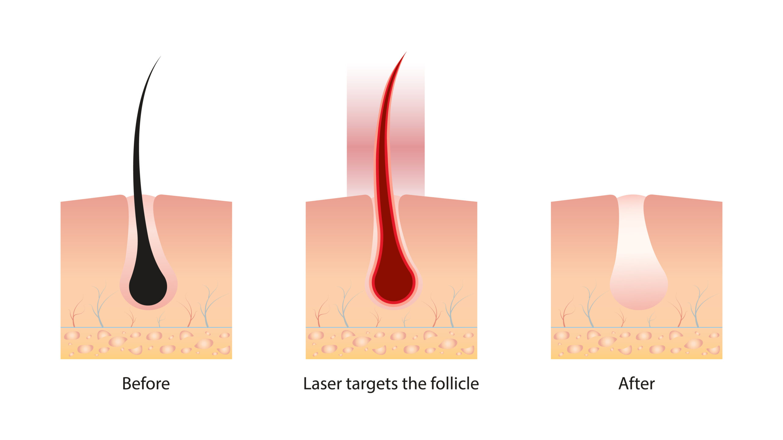 Laser Hair Removal in Thousand Oaks