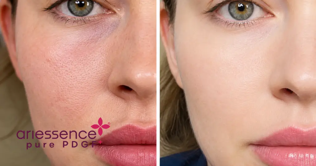 Ariessence pure PDGF